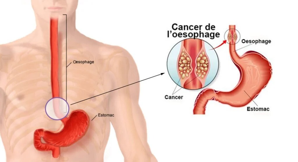 cancer œsophage et estomac traité au fenbendazole